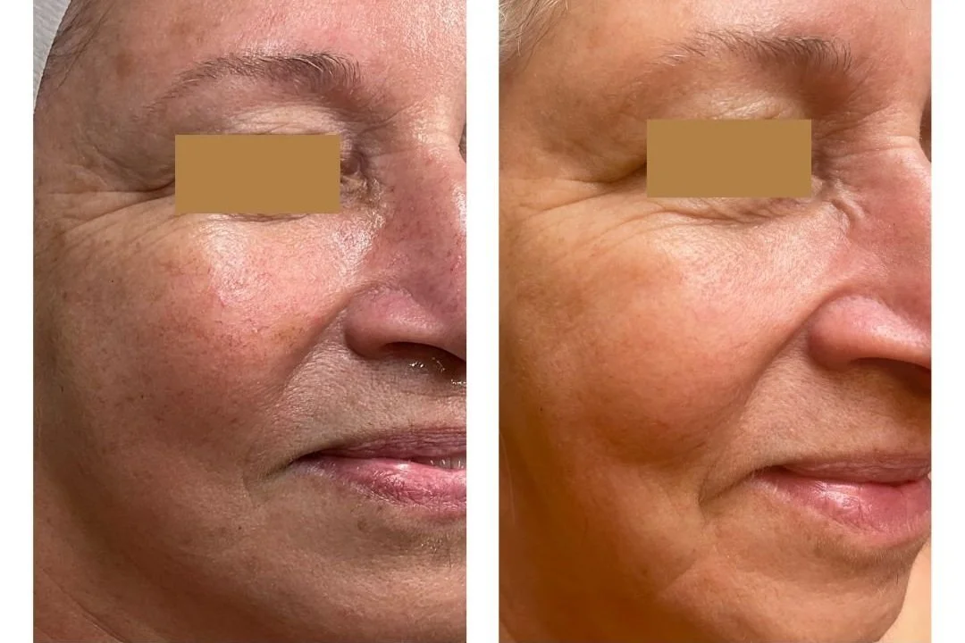 Side-by-side comparison of a woman's face before and after skincare treatment, showing reduced wrinkles and smoother skin.