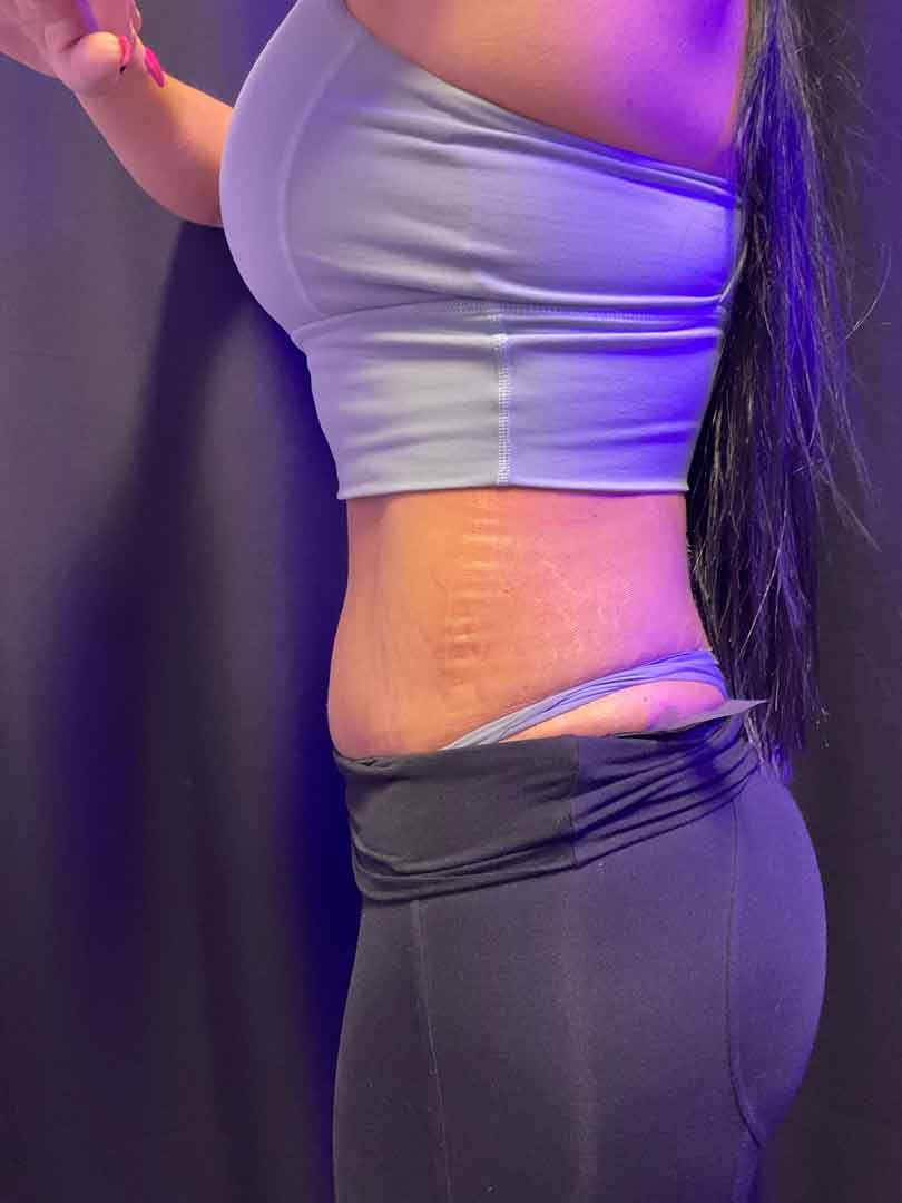B-Emsculpt-Jessica-Pena-3.jpg