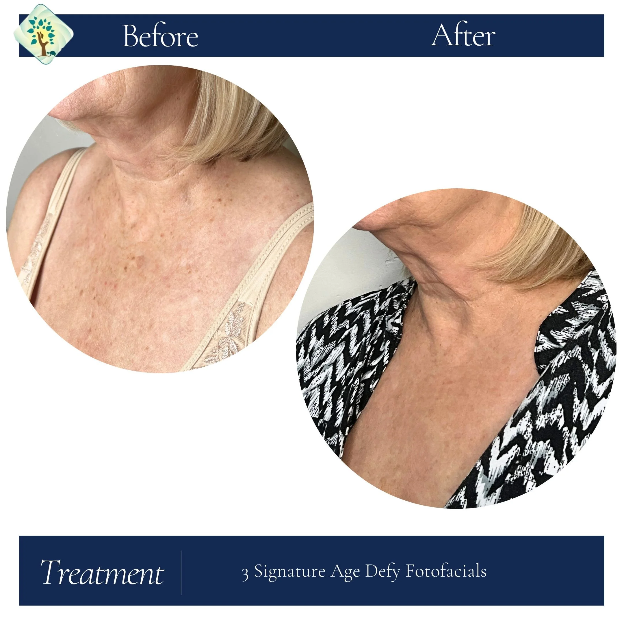 66 yr old female after 3 sig age defy fotofacials (2).jpg
