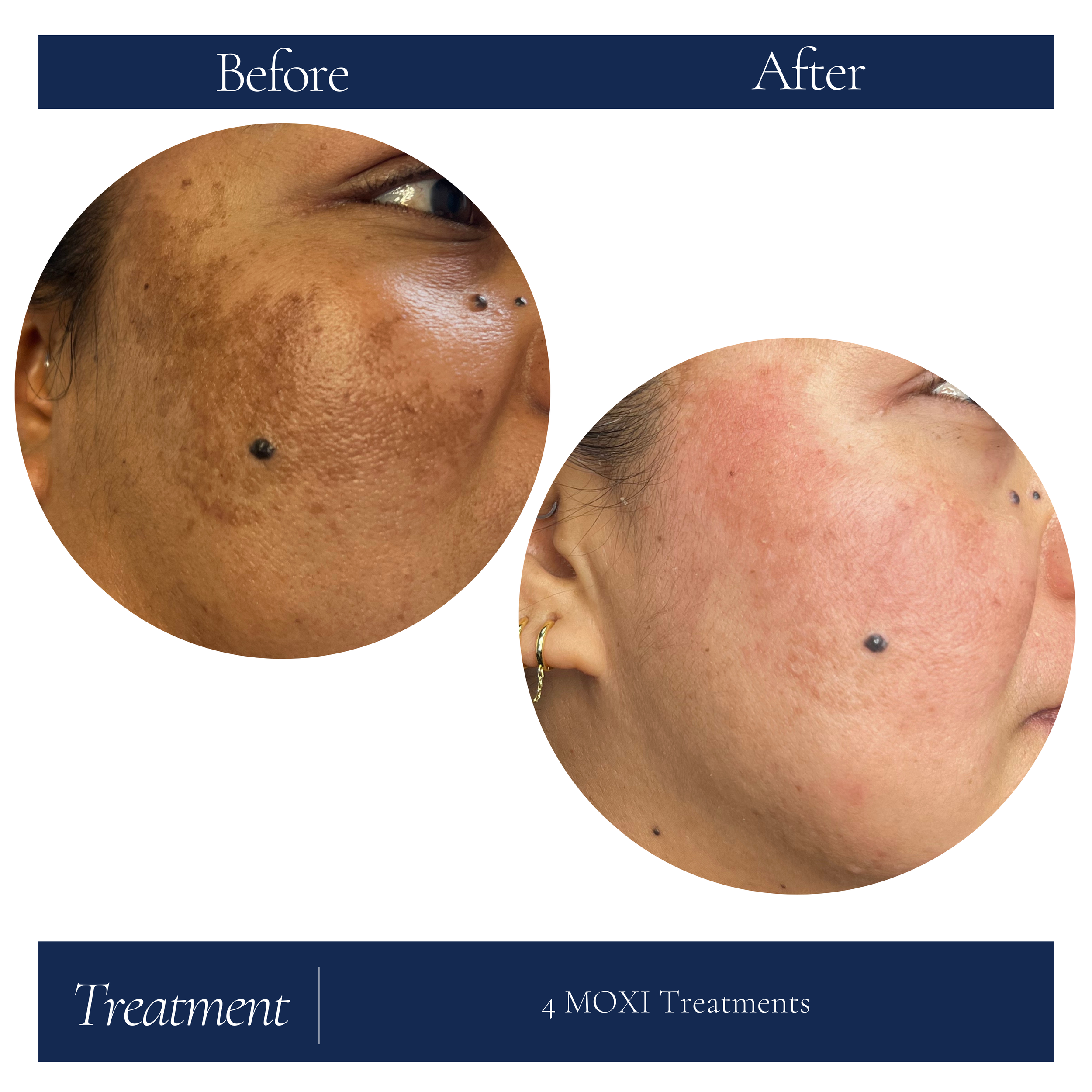 43 yr old Female Melasma pt after 4 MOXI's.png