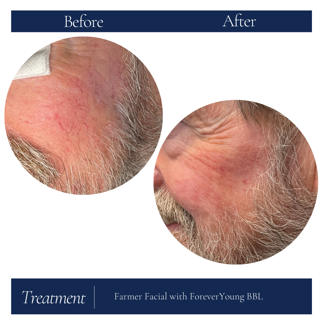 73 yr old Male after 2 tx of the farmer facial (3).png