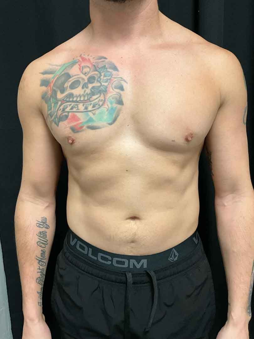 B-Emsculpt-Alex-Aragon-1.jpg