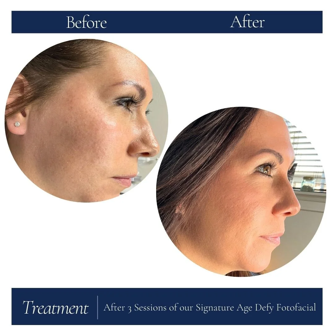 33yr old female Sig Age Defy (2).jpg