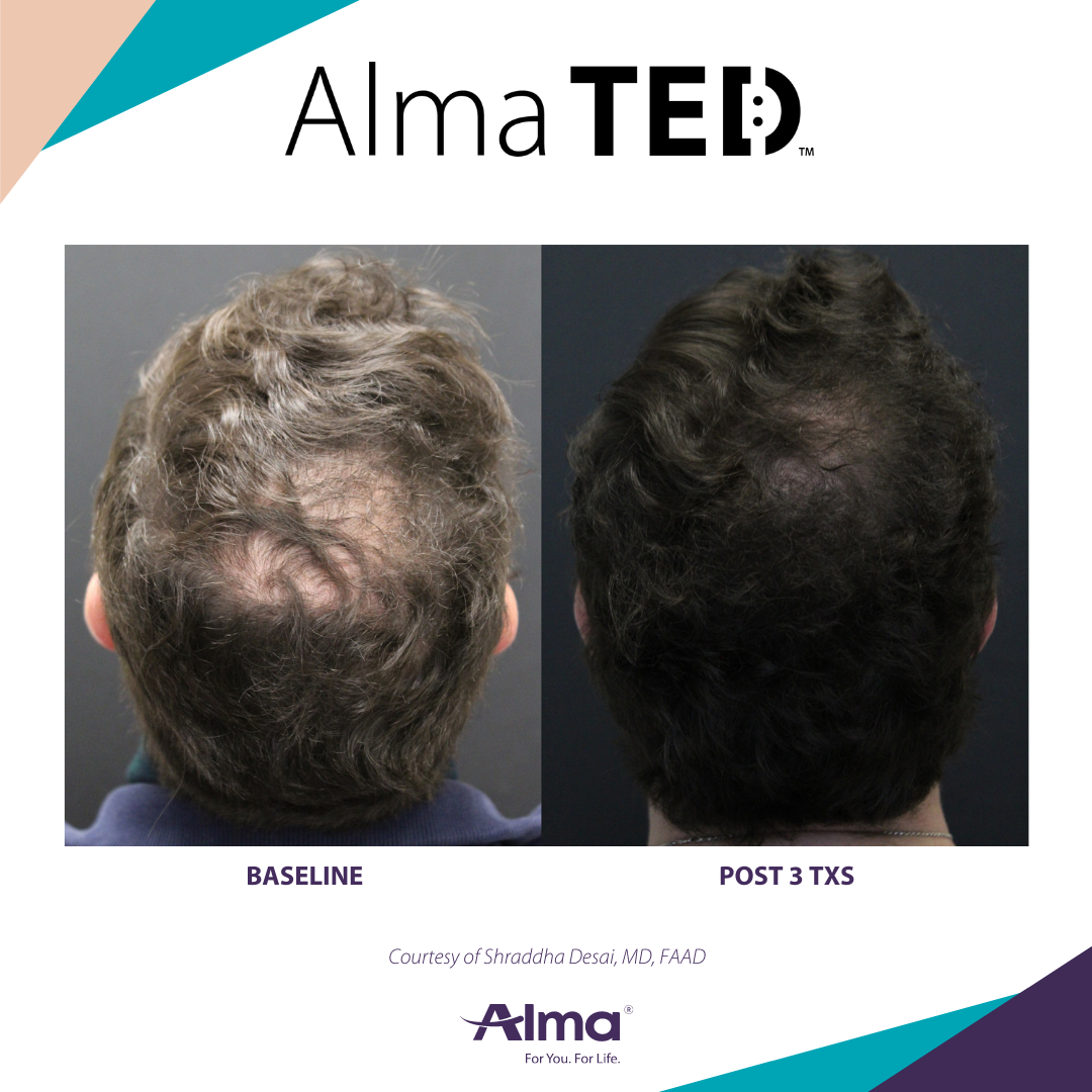 Best Hair Restoration in Clifton New Jersey for hair loss