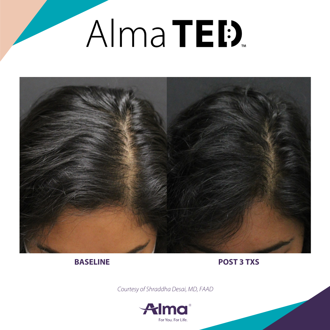 Best Hair Restoration in Clifton New Jersey for hair loss