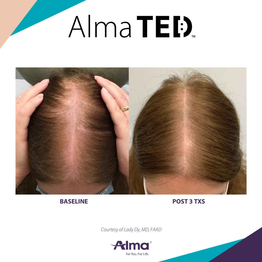 Best Hair Restoration in Clifton New Jersey for hair loss