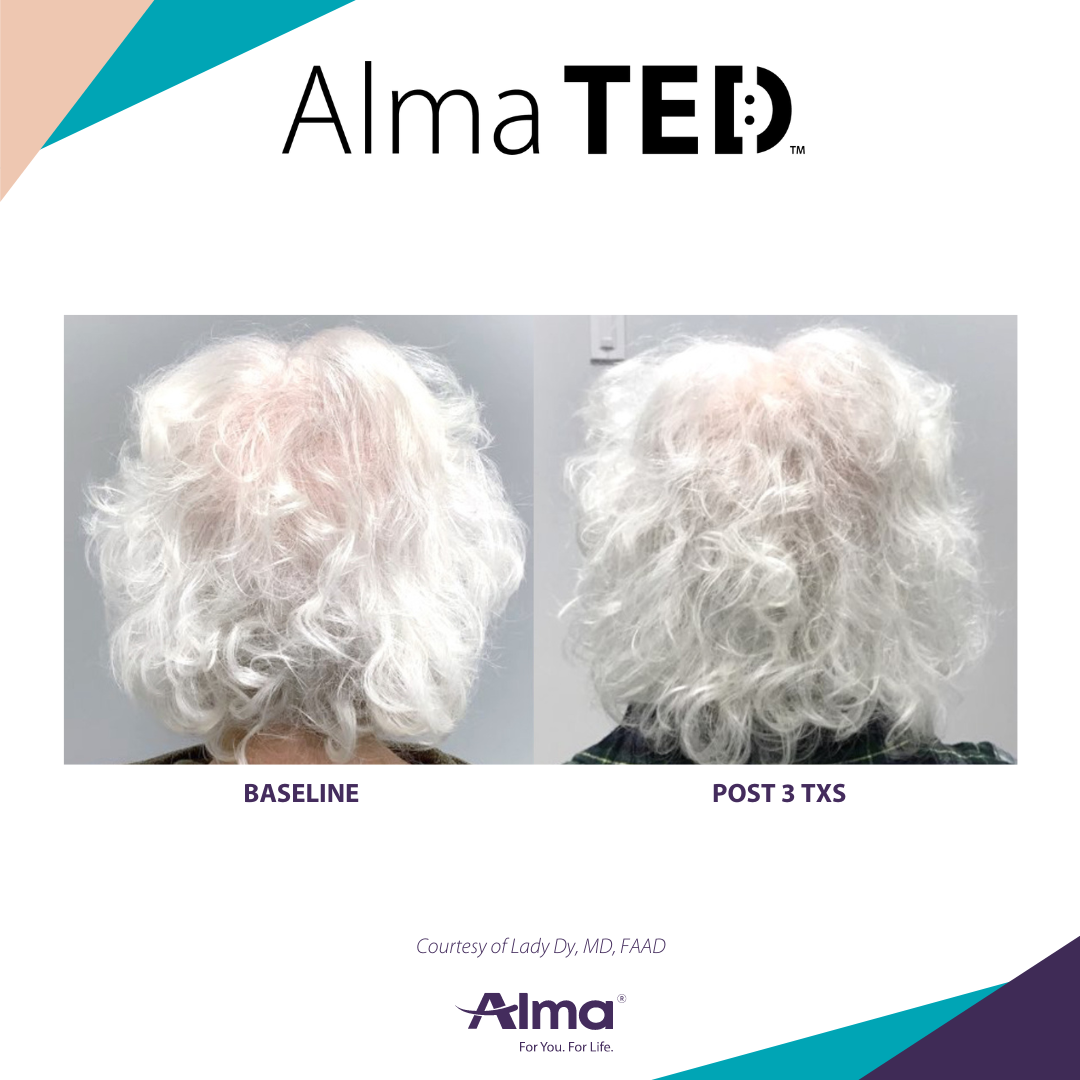 Best Hair Restoration in Clifton New Jersey for hair loss