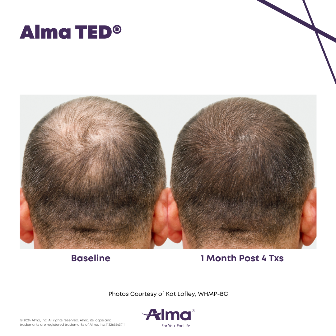 Comparison of a man's scalp showing hair density before and after 1 month of treatment, with labels 'Baseline' and '1 Month Post 4 Txs'.