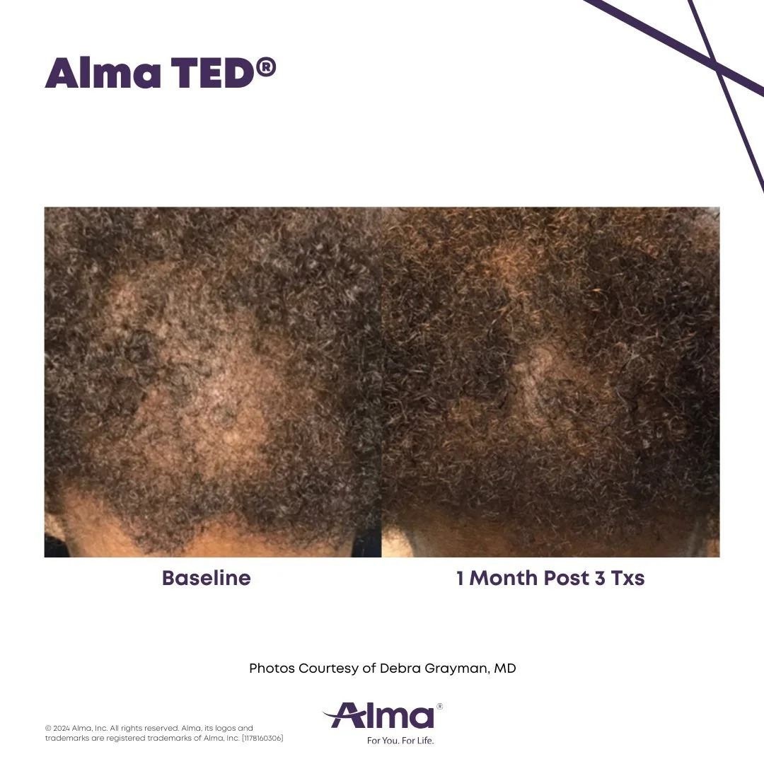 Comparison of scalp hair before and after one month of treatment, showing increased hair density and fullness.