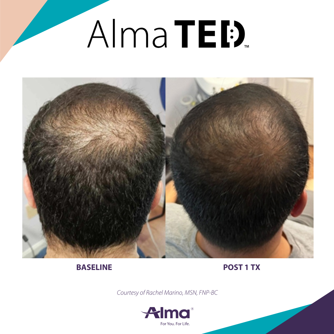 Best Hair Restoration in Clifton New Jersey for hair loss for men and women