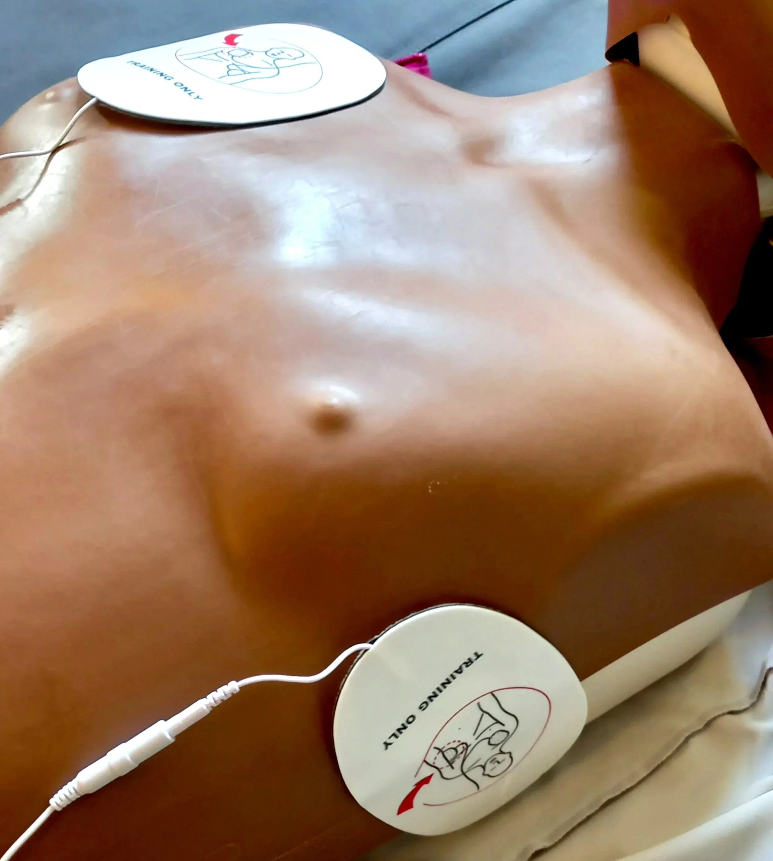Am image showing the torso of a dark skin resuscitation training manikin.  Defibrillator pads are placed on the manikin.  One pad is placed just below the right collar bone, and the second pad is placed just below the left armpit.