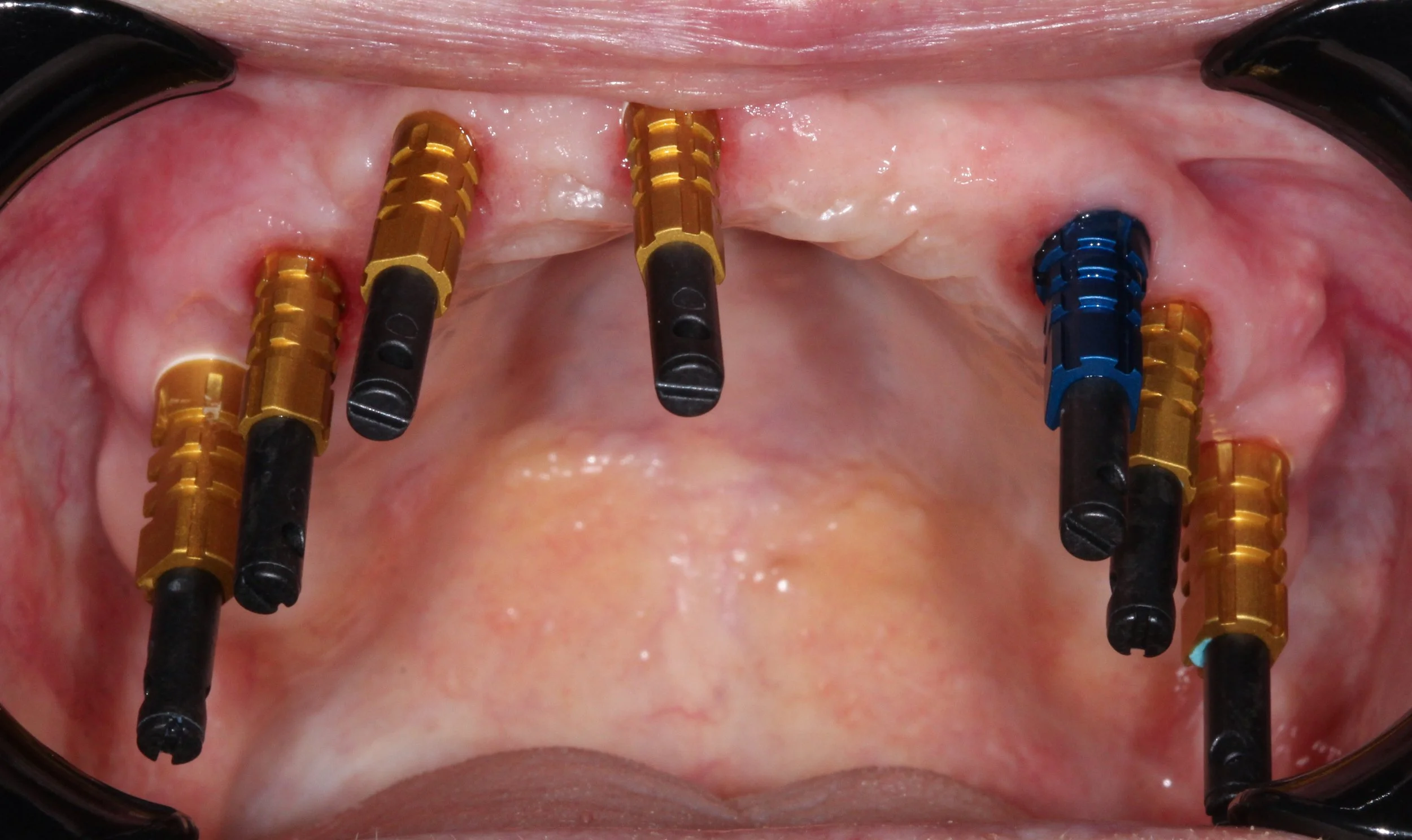 Upper impression copings.jpg