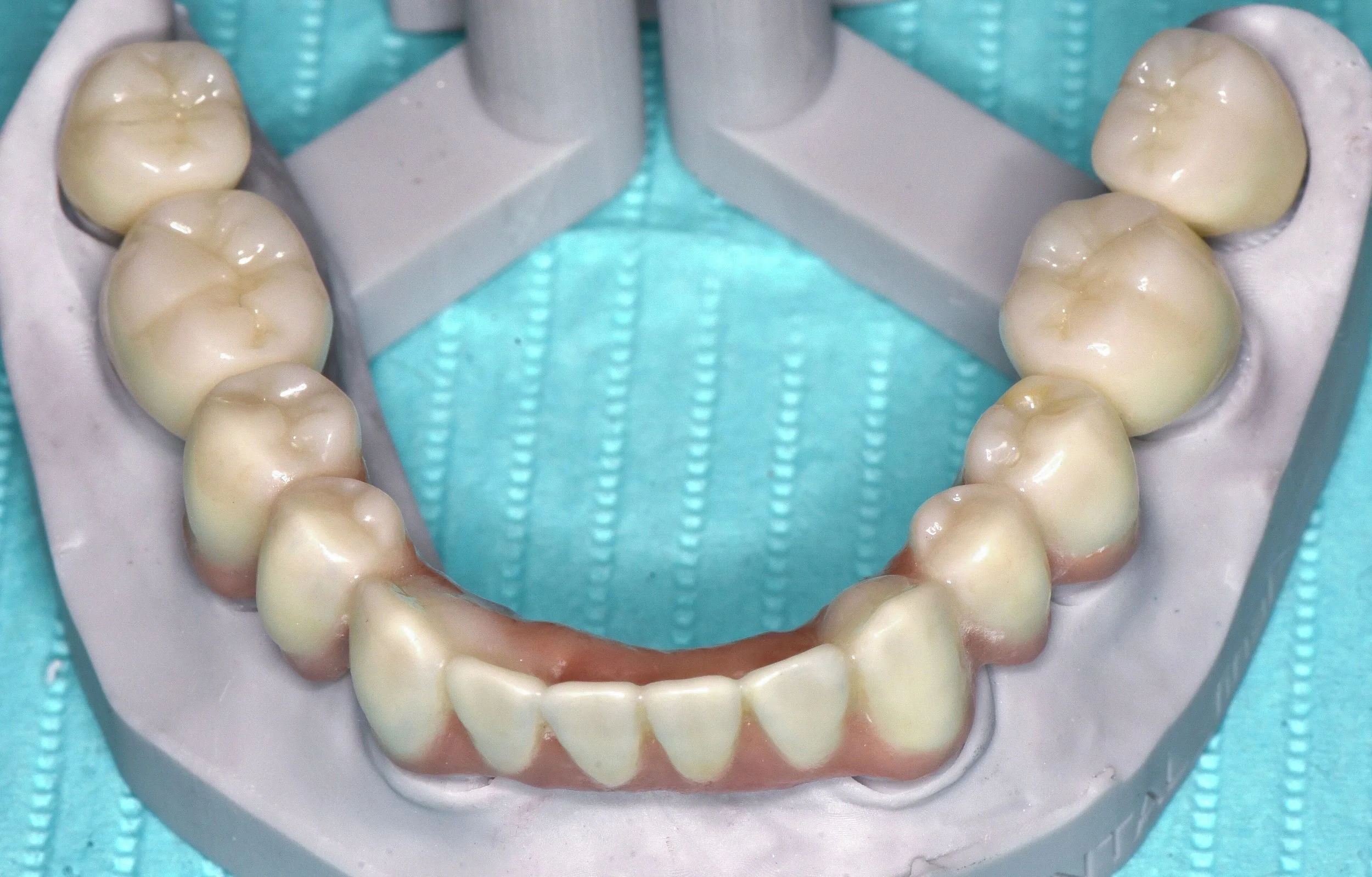 Lower final prosthetics molar crowns, anterior bridge.jpg
