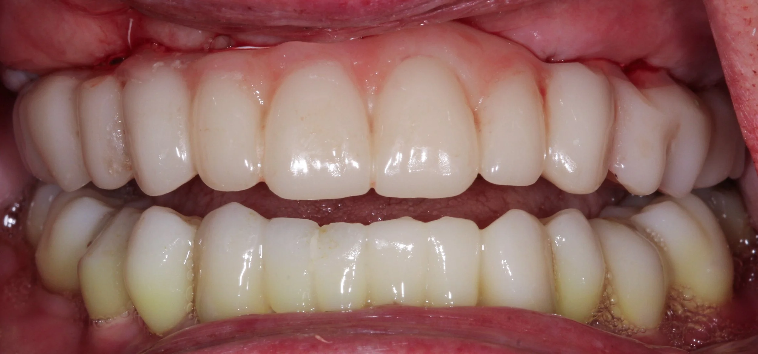 H. Madsen dual arch.jpg