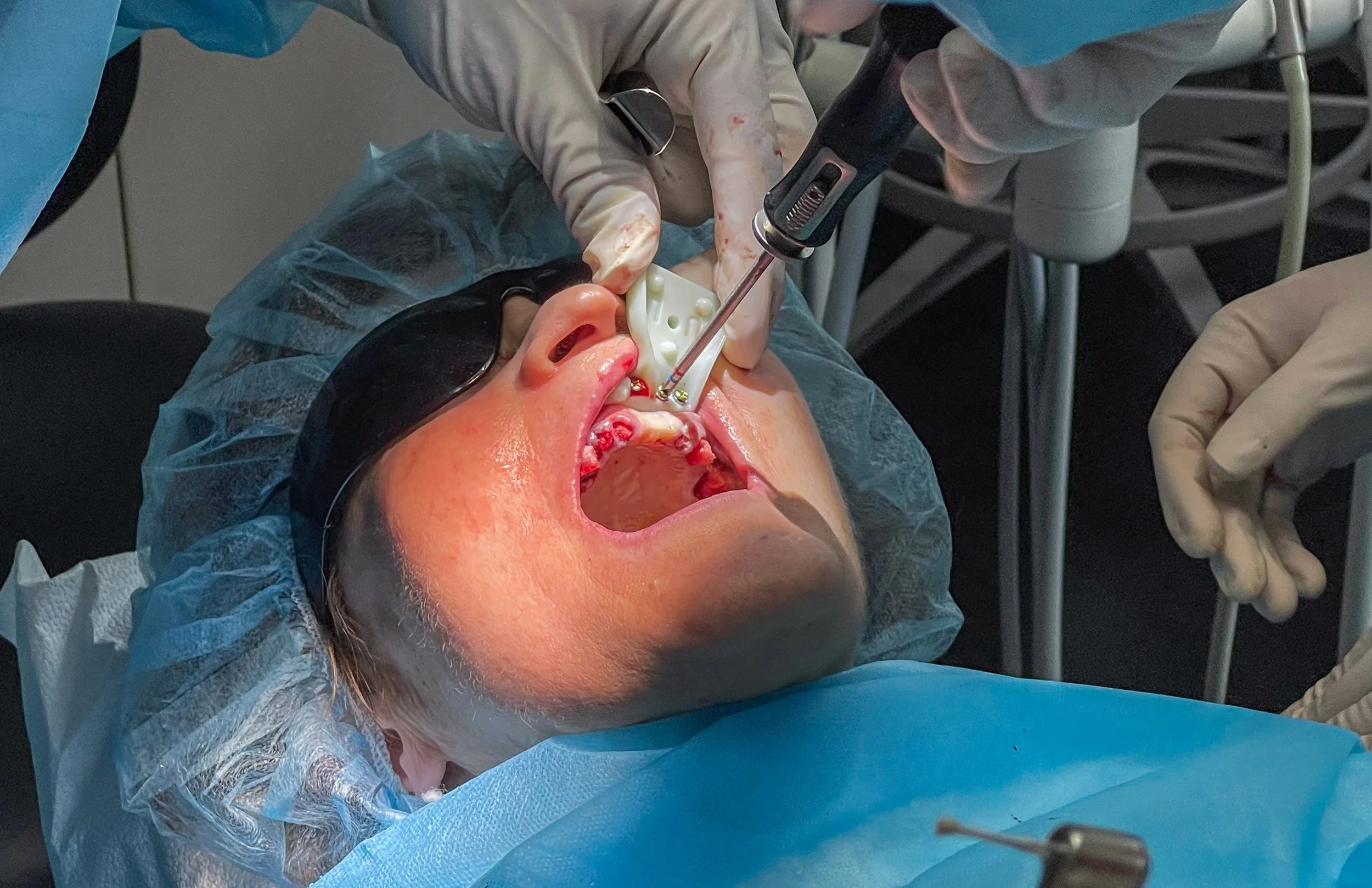 Fixation of patient tracker after exodontia.jpg