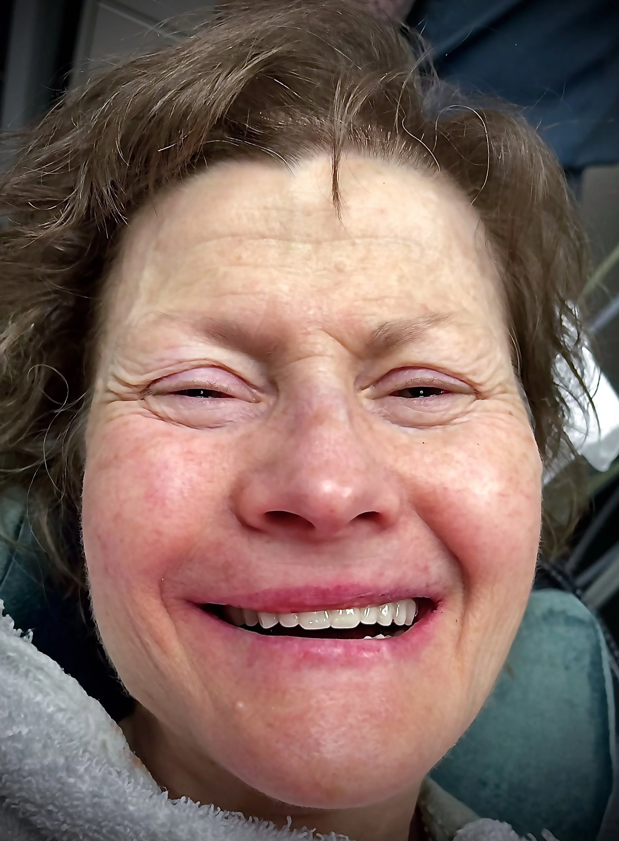 Facial esthetic improvement immediately post-op.jpg