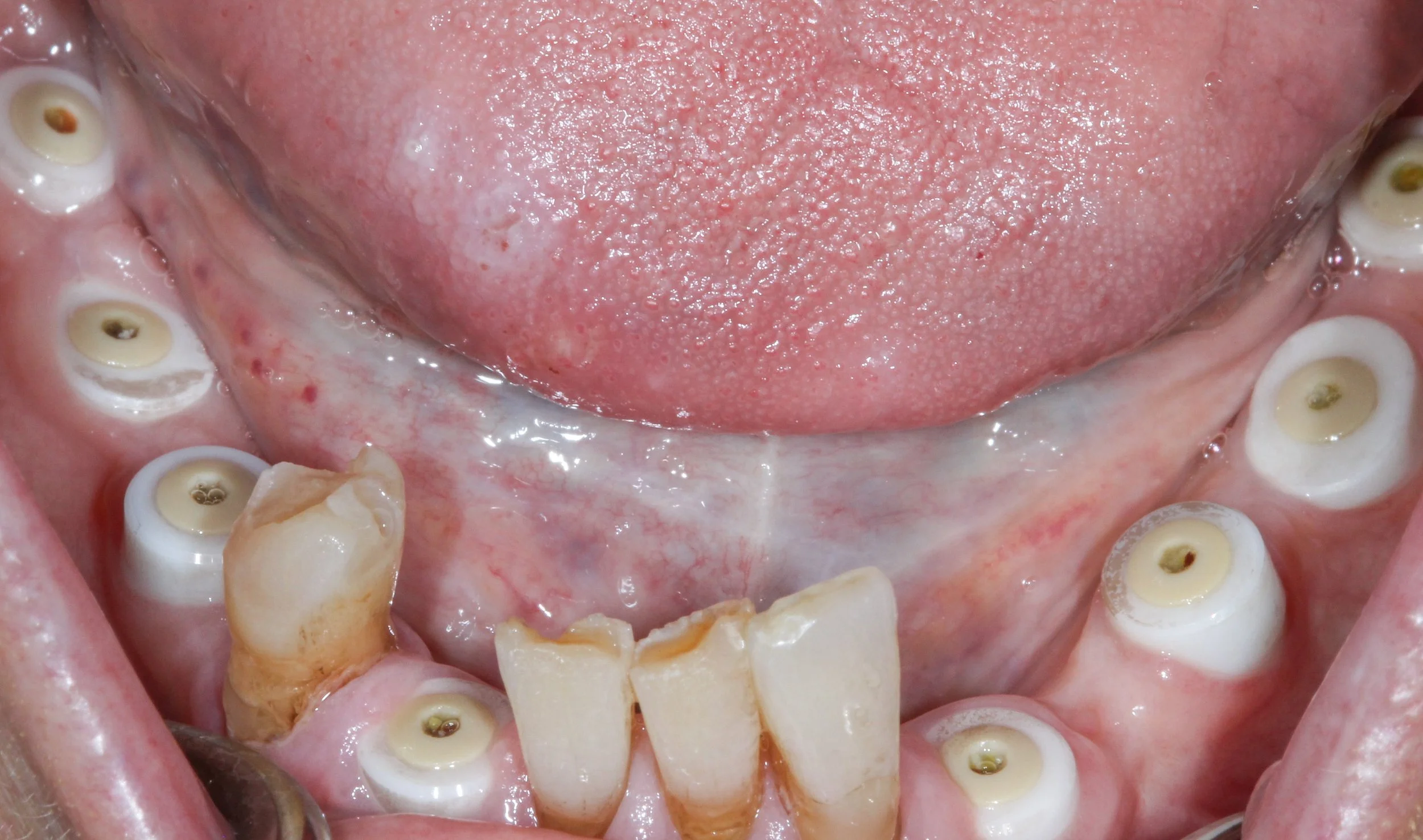 H. Madsen lower healed.jpg