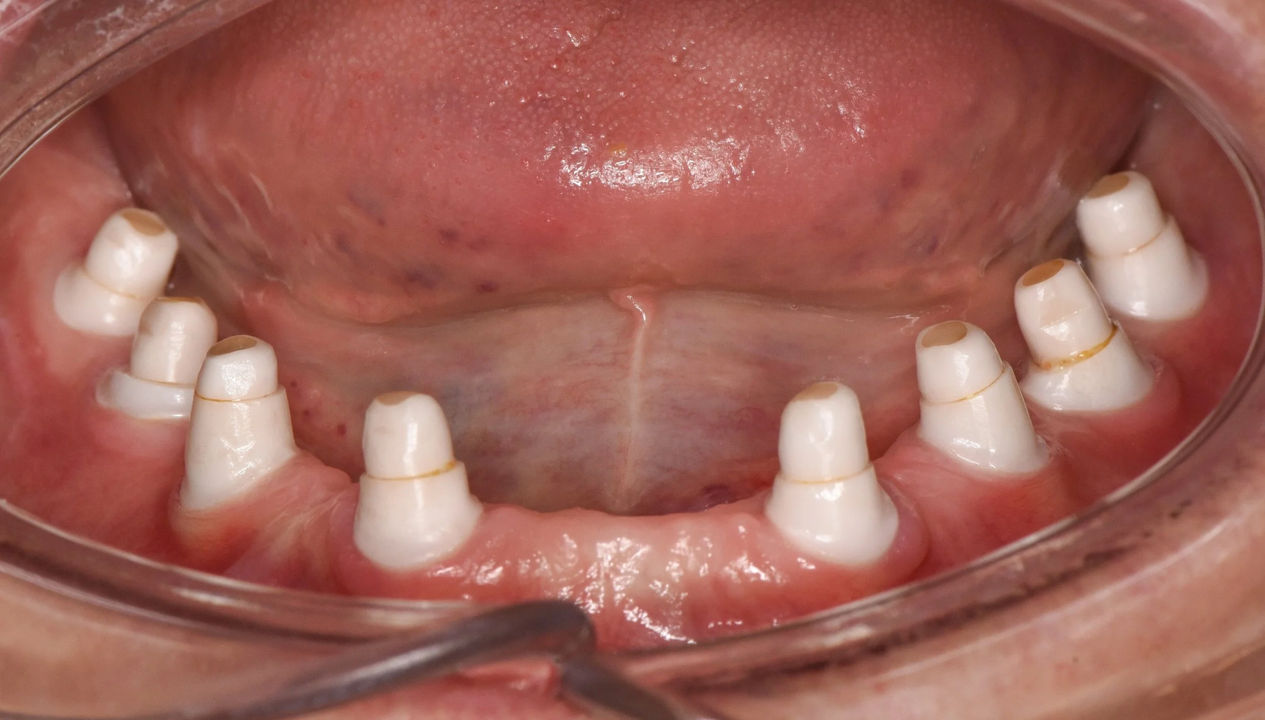 Lower final abutment preparations.jpg