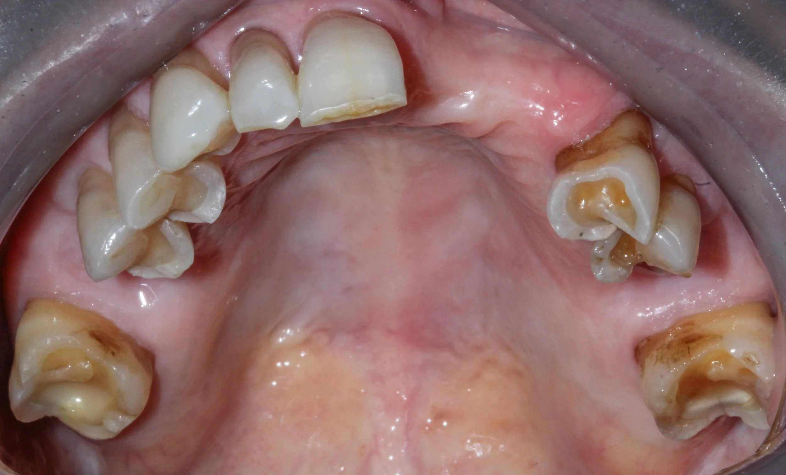 H. Madsen Upper pre-op.jpg