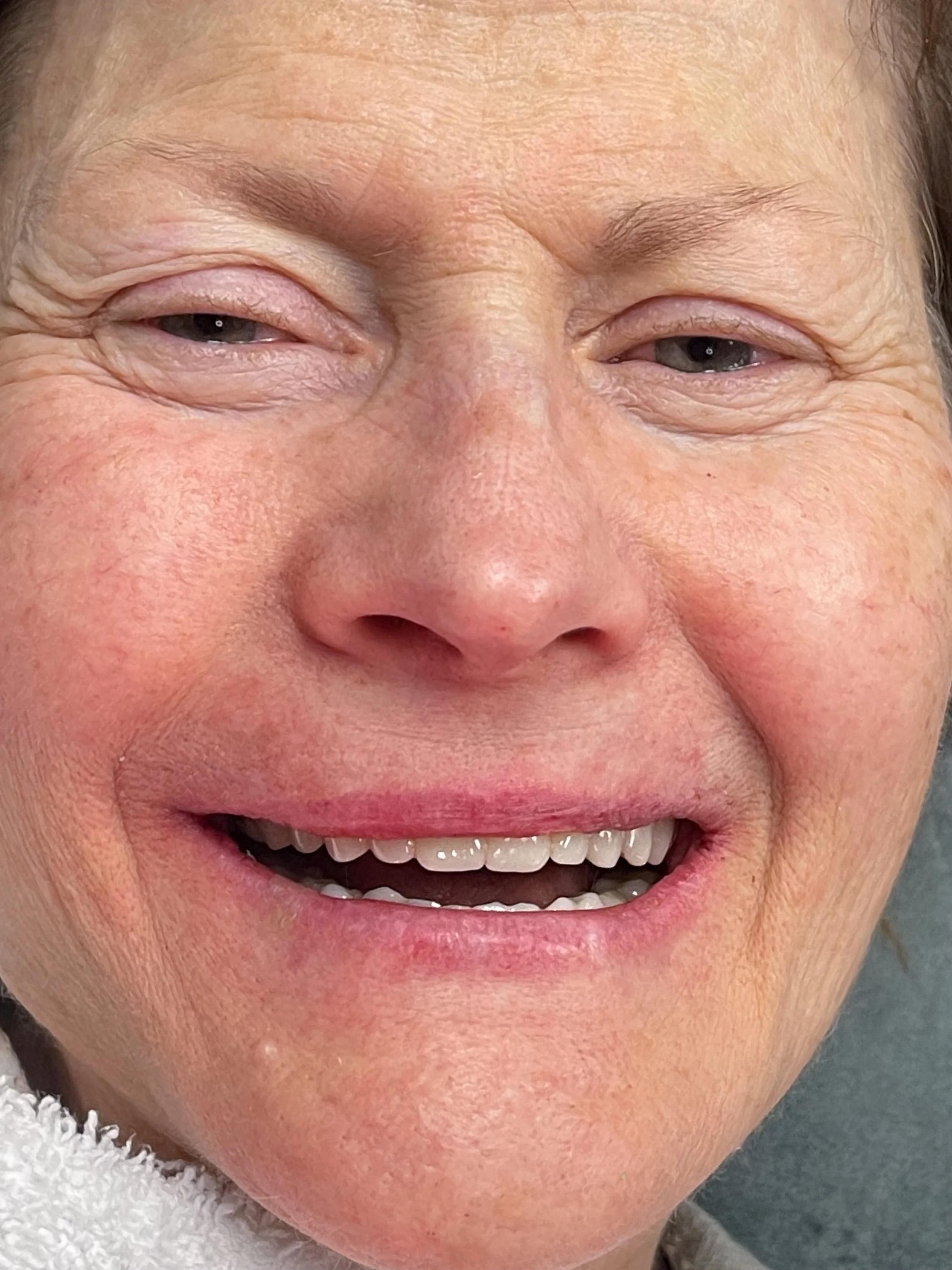 Immediate Post-operative face photo.jpg