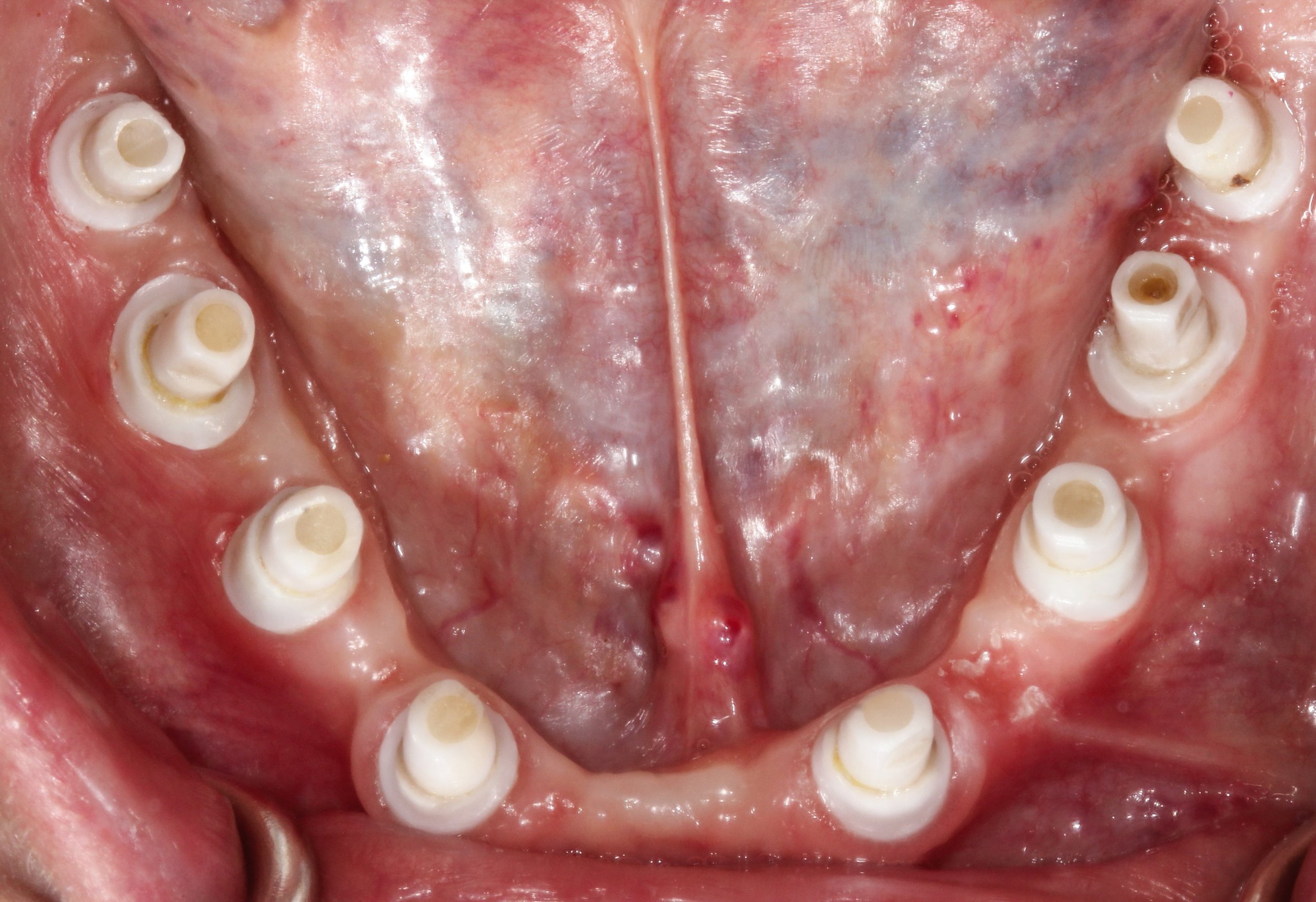 H. Madsen lower implants.jpg