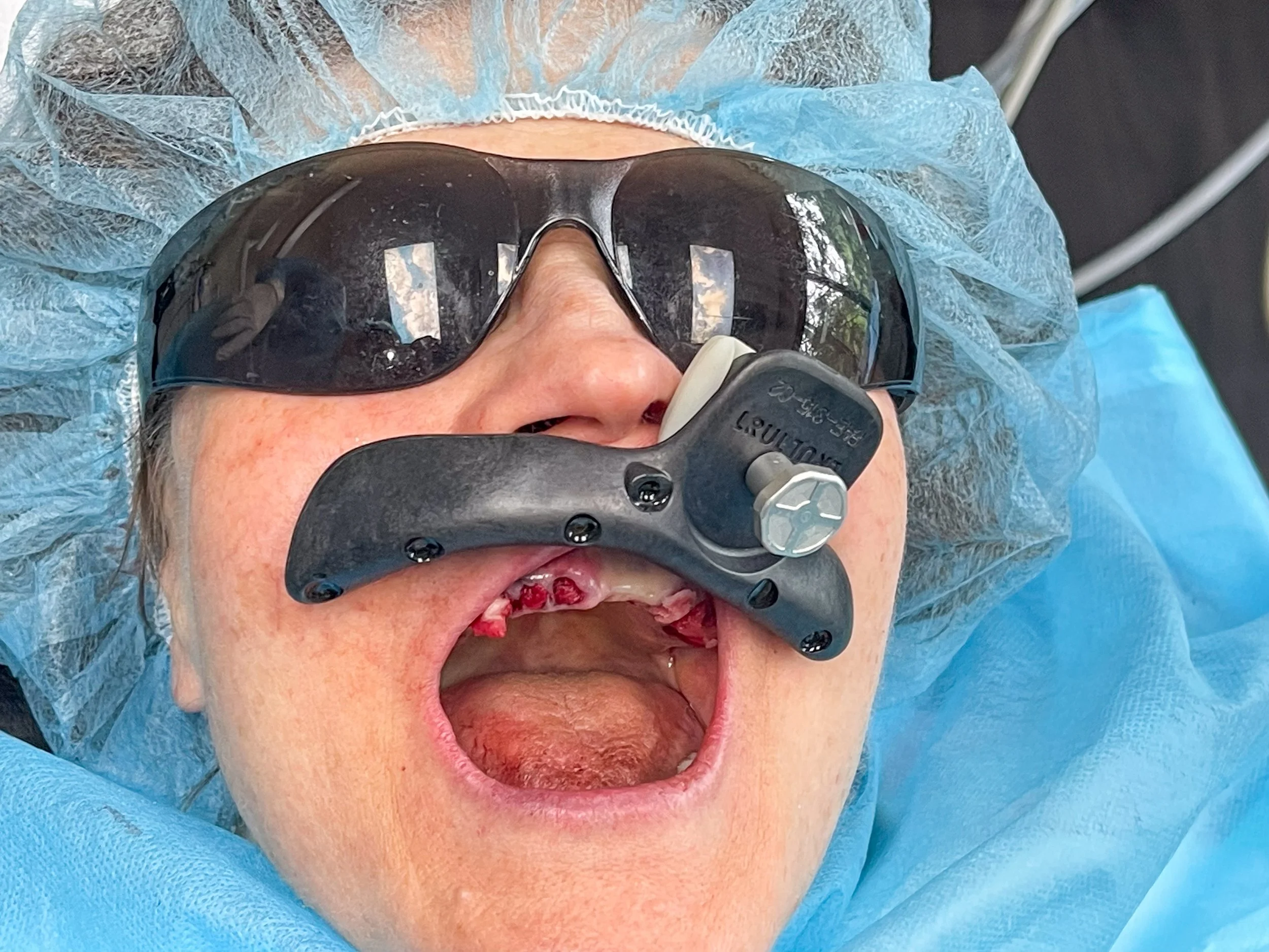 Fiducial array attached to patient tracker.jpg