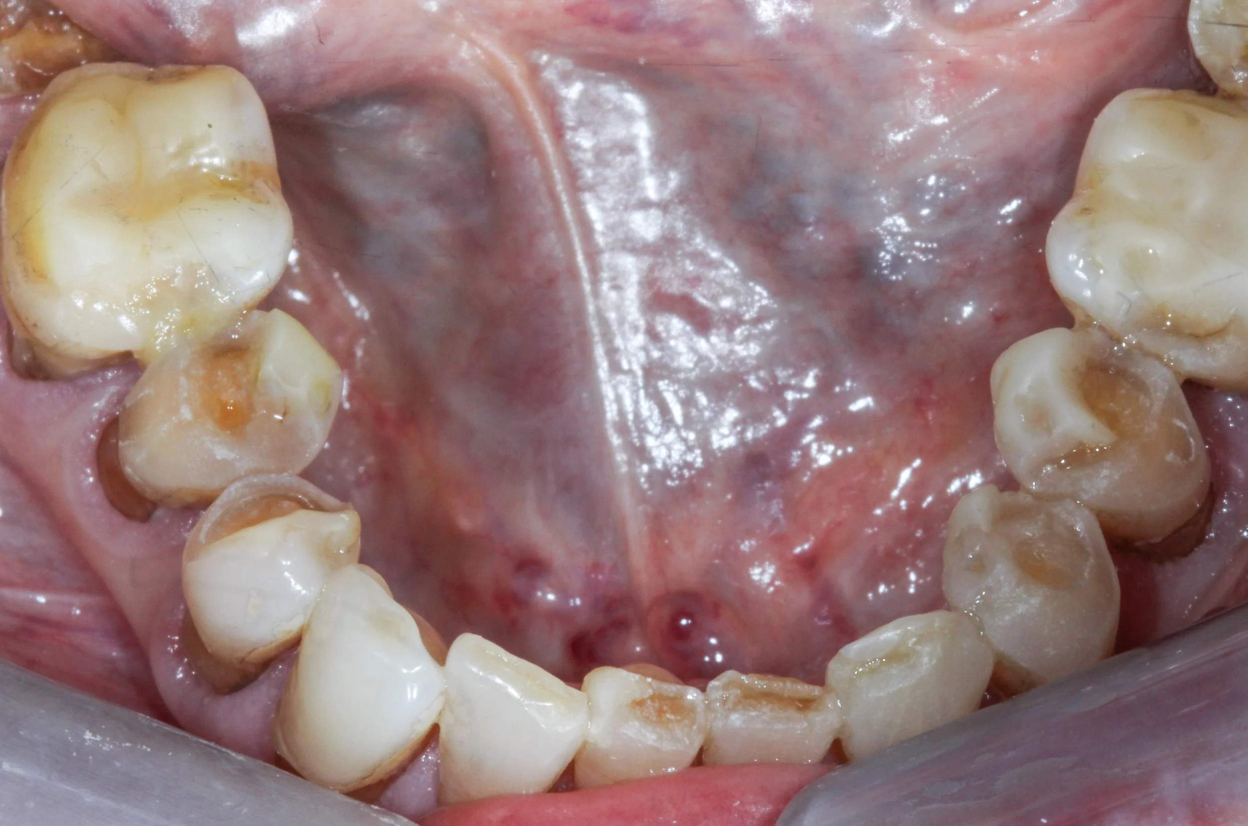 H. Madsen Lower pre-op.jpg