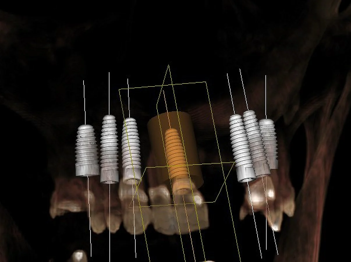 Initial surgical plan for maxillary arch.jpg