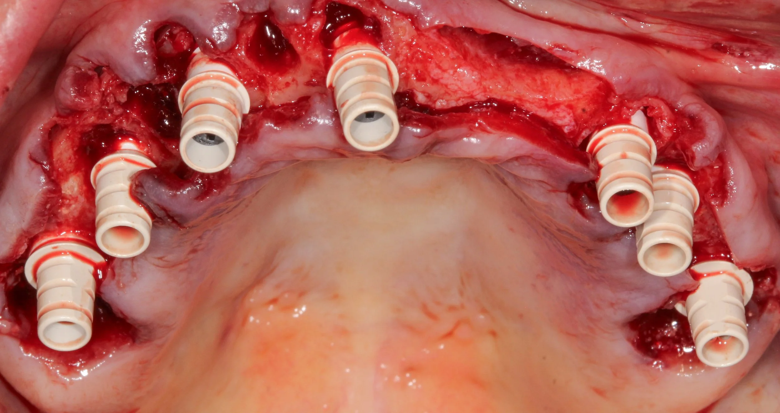 H. Madsen Upper implants.jpg