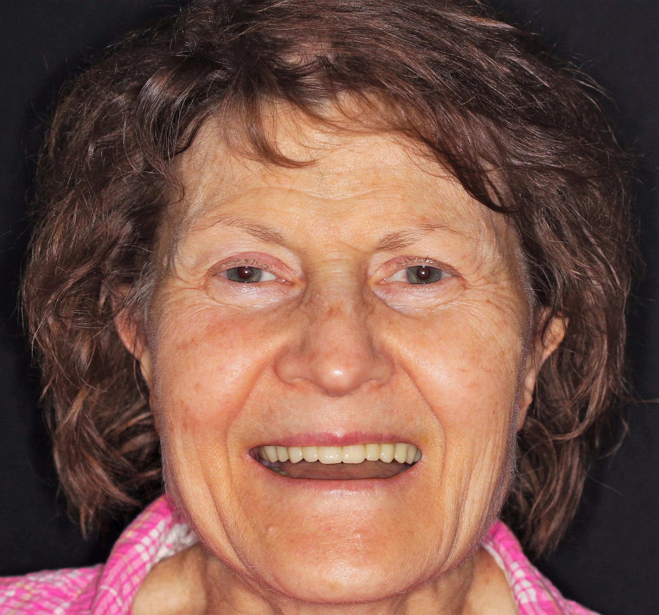 Excellent facial esthetics two-weeks post-operatively.jpg