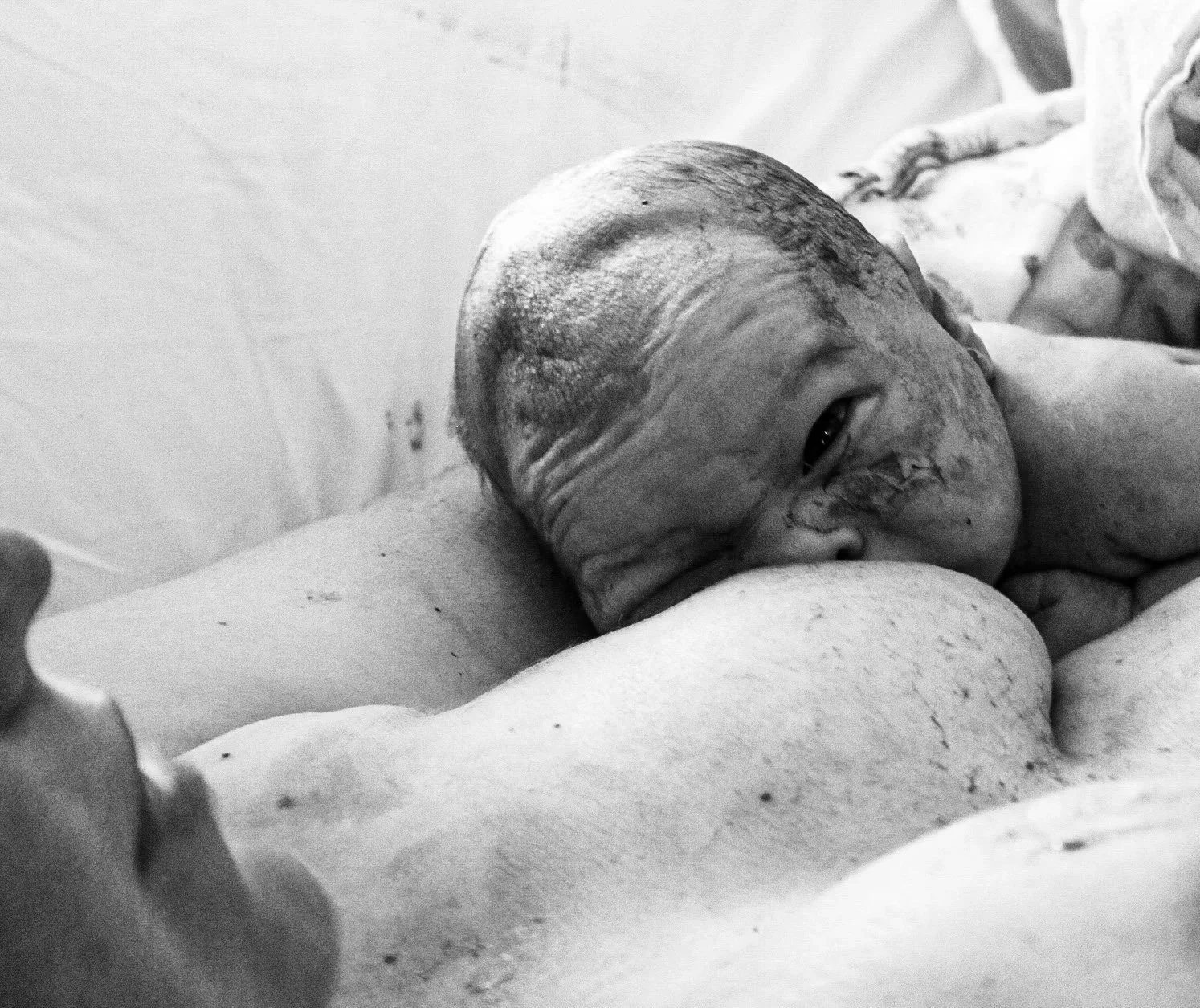 A premature baby lying on a person's chest, looking at the camera, with visible signs of a difficult birth or health issues. The scene is in black and white, showing the baby's face and upper body.