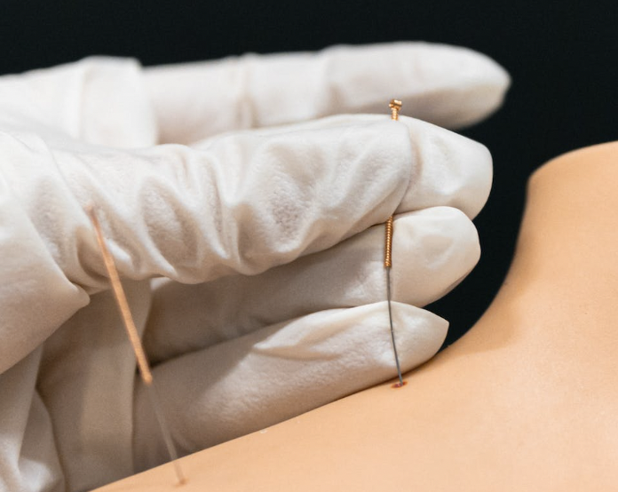 Understanding IT Band Syndrome and the Role of Acupuncture in ...