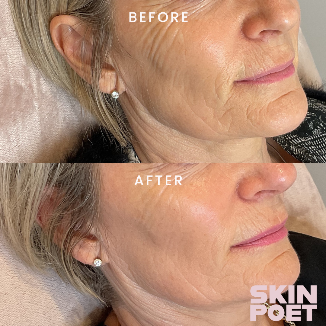 Biostimulators vs Skin Boosters: Radiesse, Sunekos and Belotero Revive Explained