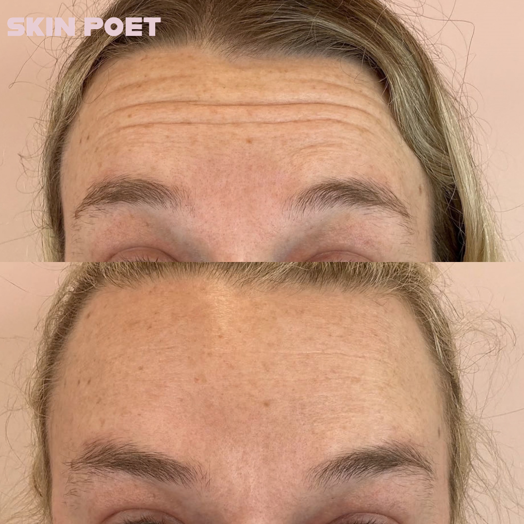 Botox vs Dysport vs Xeomin: What's the Difference (And Why I Only Use One)