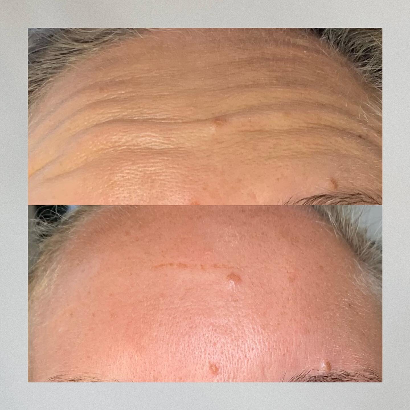 𝗕𝗼𝘁𝗼𝘅 before &amp; after&mdash;smooth as butter! 🧈

Botox may be the perfect solution if you're looking for a non-surgical way to rejuvenate your appearance. Contact us today to schedule a consultation and learn more about this amazing treatmen