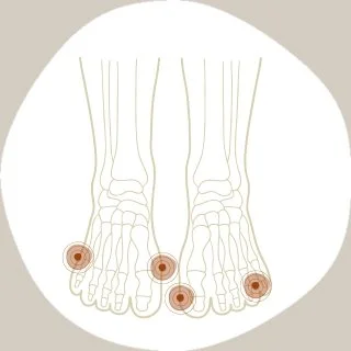 foot-injuries-corns-calluses.jpg