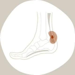 foot-pain-achilles-tendinopathy.jpg