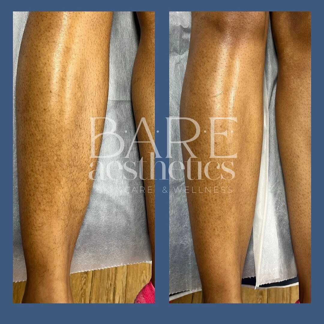 #sugar #sugarhairremoval #bare #esthetics #esthetician  Book B.A.R.E.