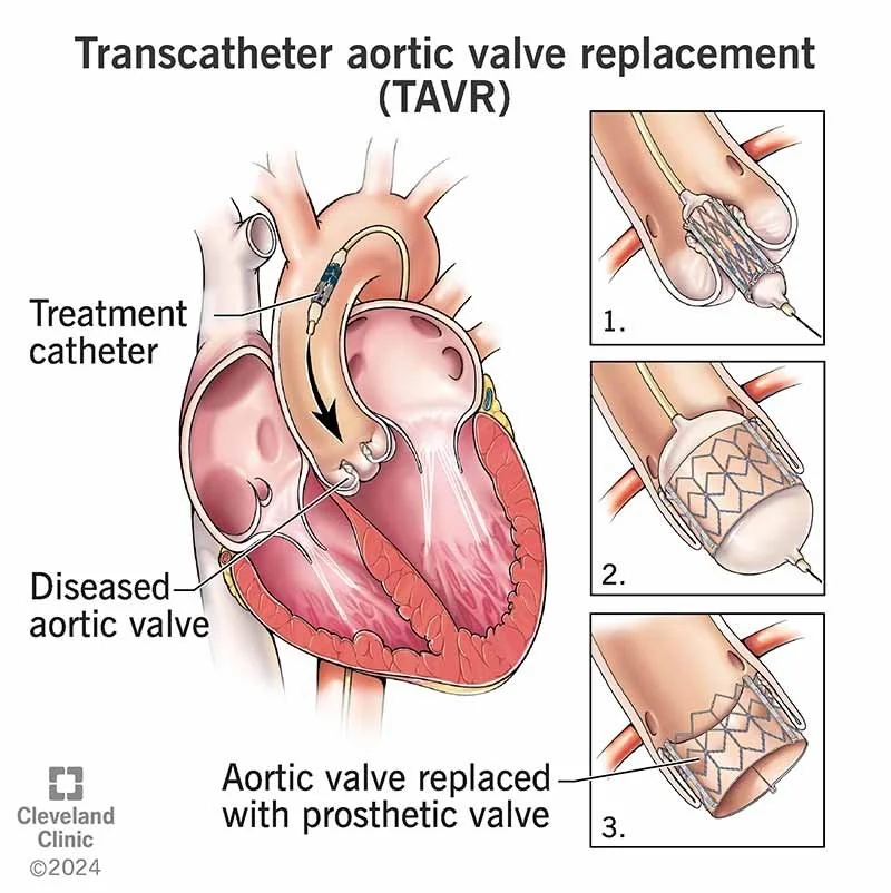 TAVI Transcatheter Aortic Valve Implantation Minimally Invasive tavi-transcatheter-aortic-valve-implantation-minimally-invasive