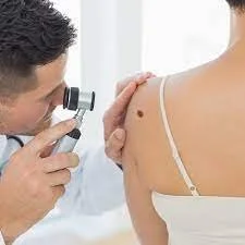 Mole Monitoring in Medford: When to Worry and What to Watch