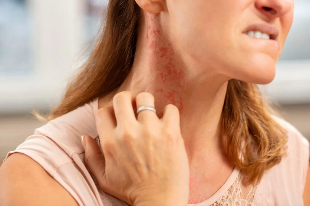 Spring Allergies and Your Skin: How to Calm Irritation and Redness
