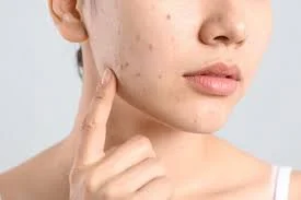 What Over-the-Counter Skincare Can (and Can’t) Do