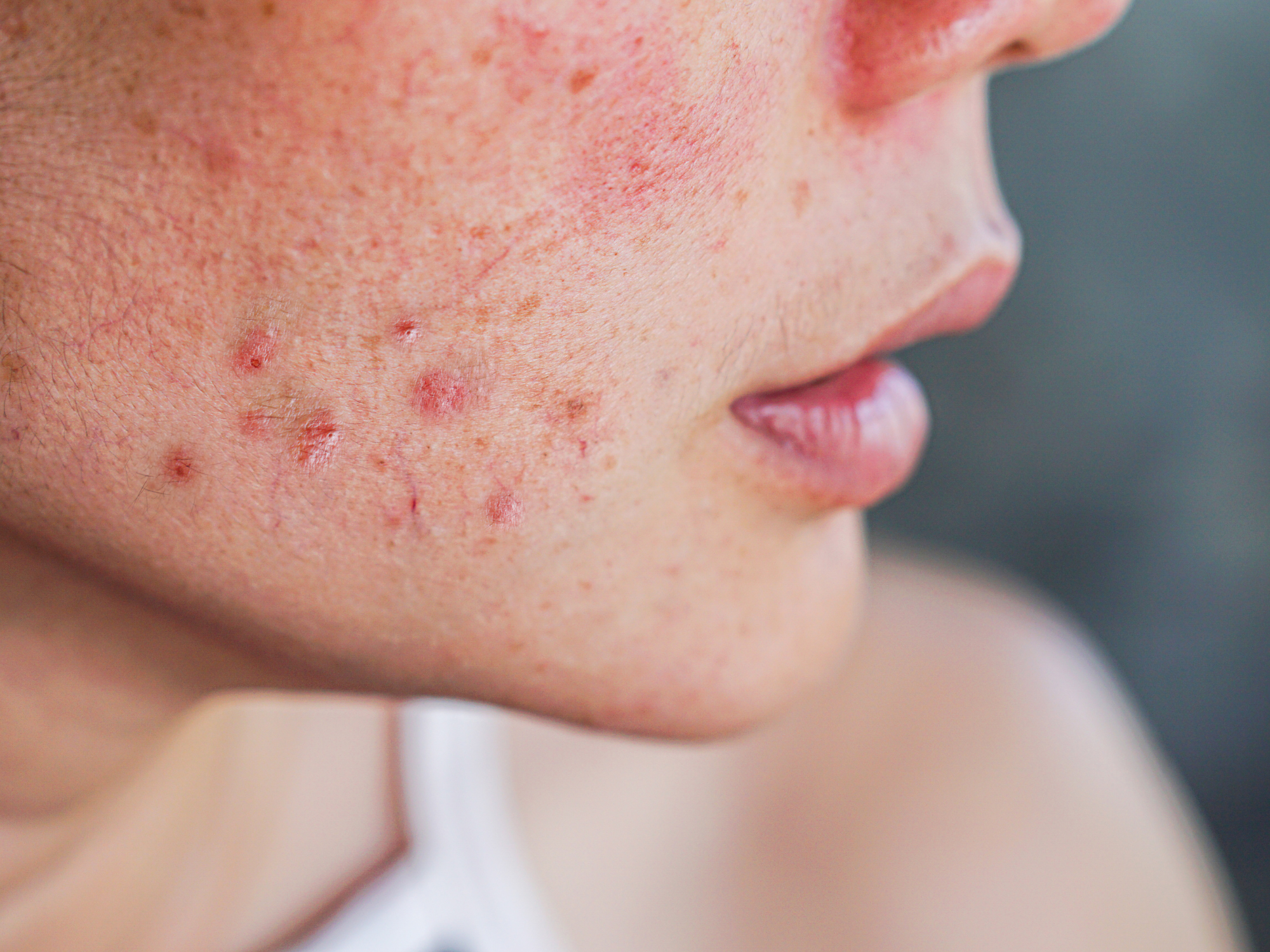 Derm-Acne.png