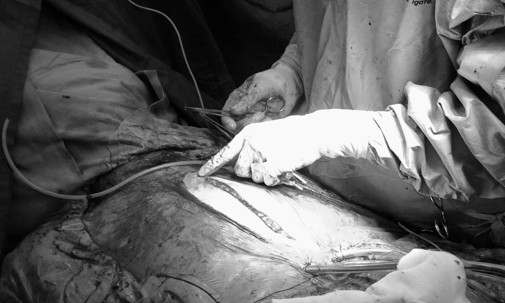 Surgical Assistant suturing skin at the completion of heart surgery