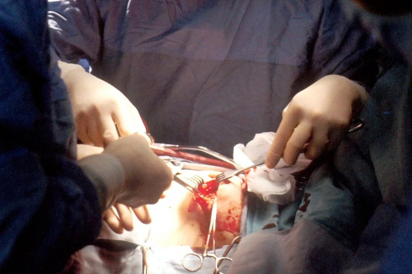 Surgeon and Assistant performing pericardial drainage via left anterior thoracotomy