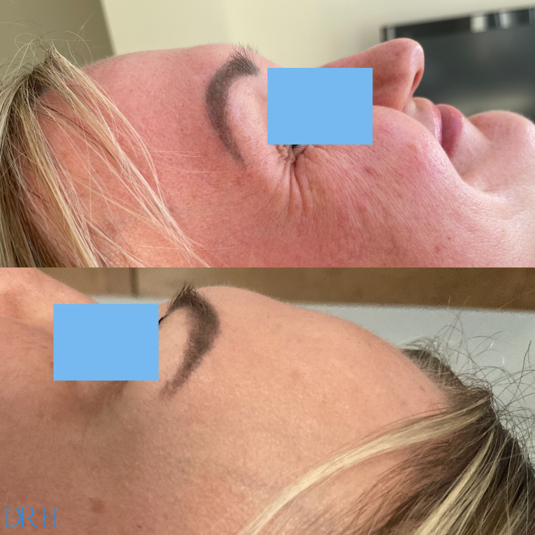 Anti-wrinkle injections to crows feet