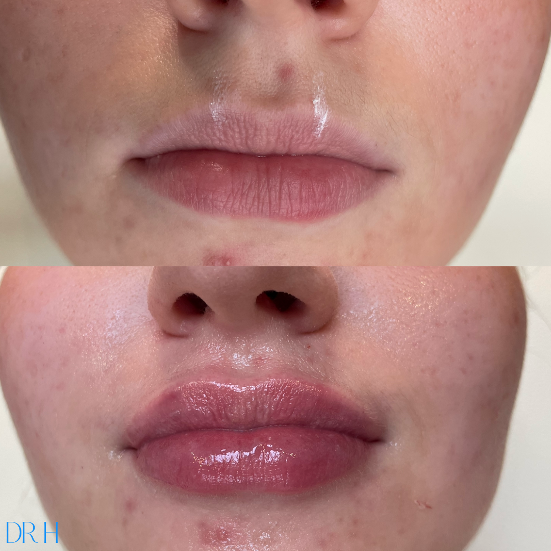 Juvaderm filler into the lips