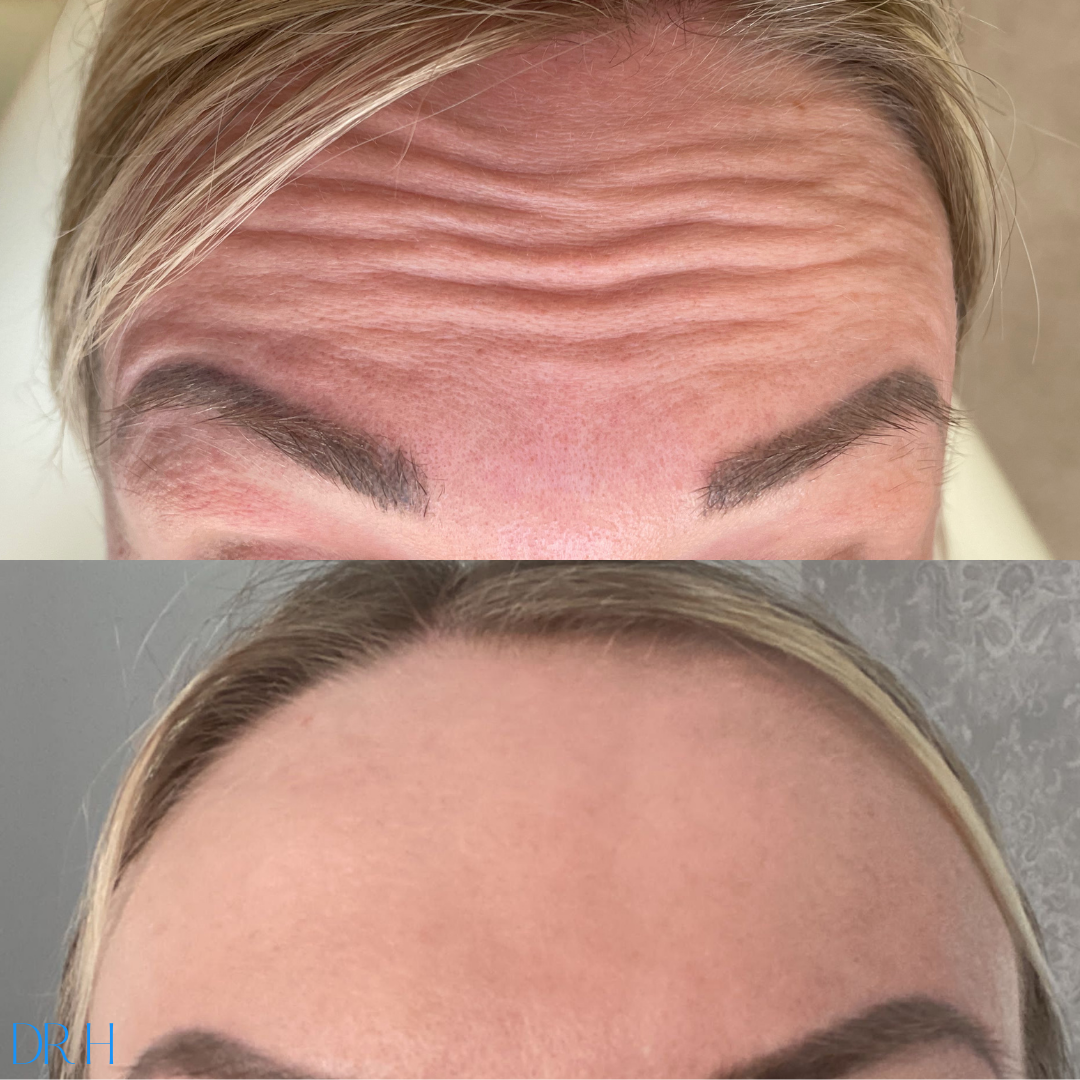 Anti-wrinkle injections to the forehead