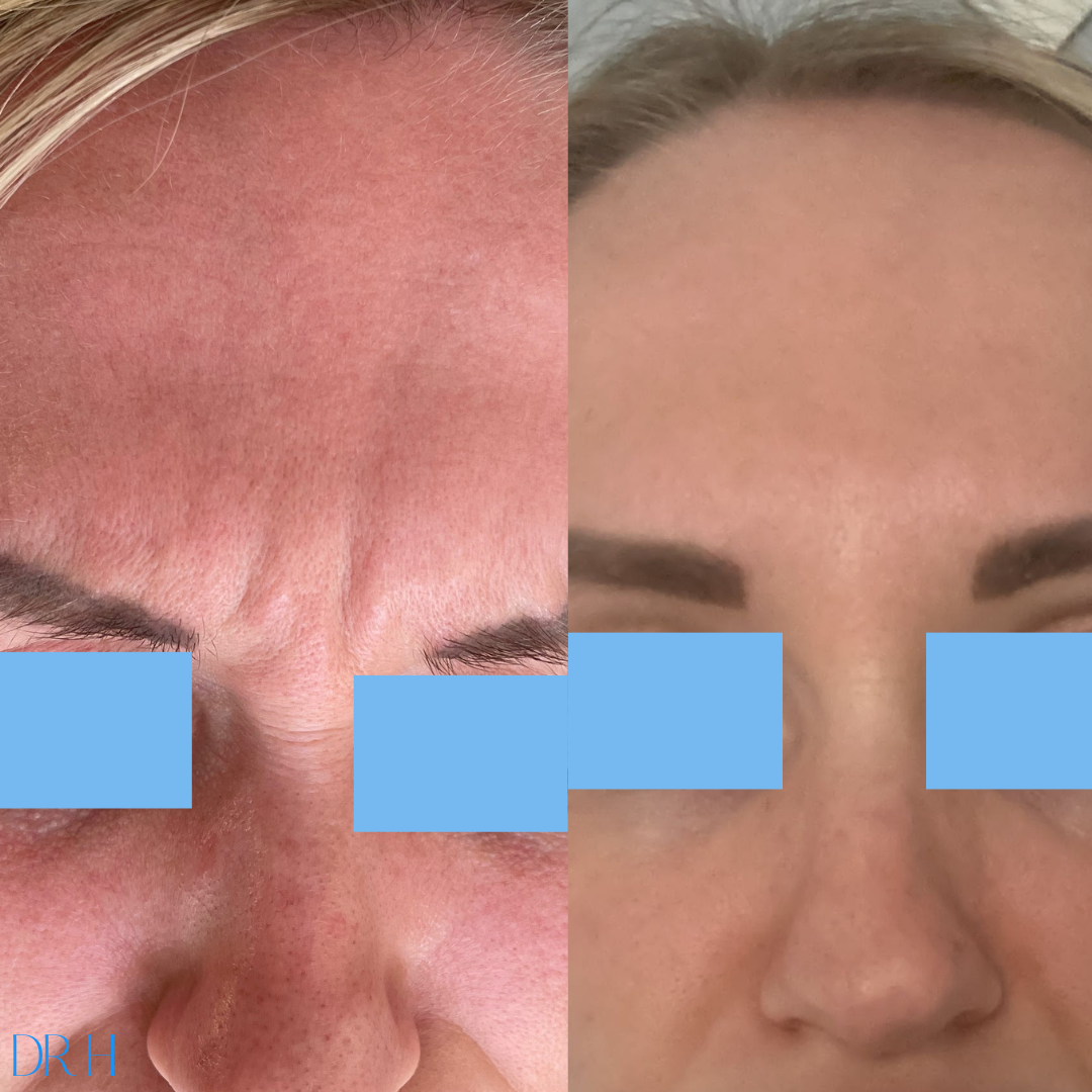 Anti-wrinkle injections to frown