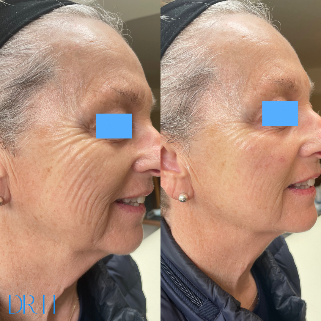 Juvaderm filler into the cheeks